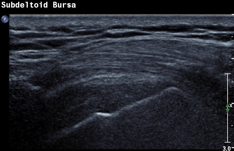Shoulder Ultrasound Bursitis
